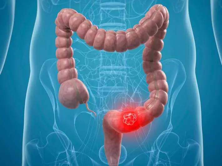سرطان القولون الأعراض وتحاليل الكشف المبكر
