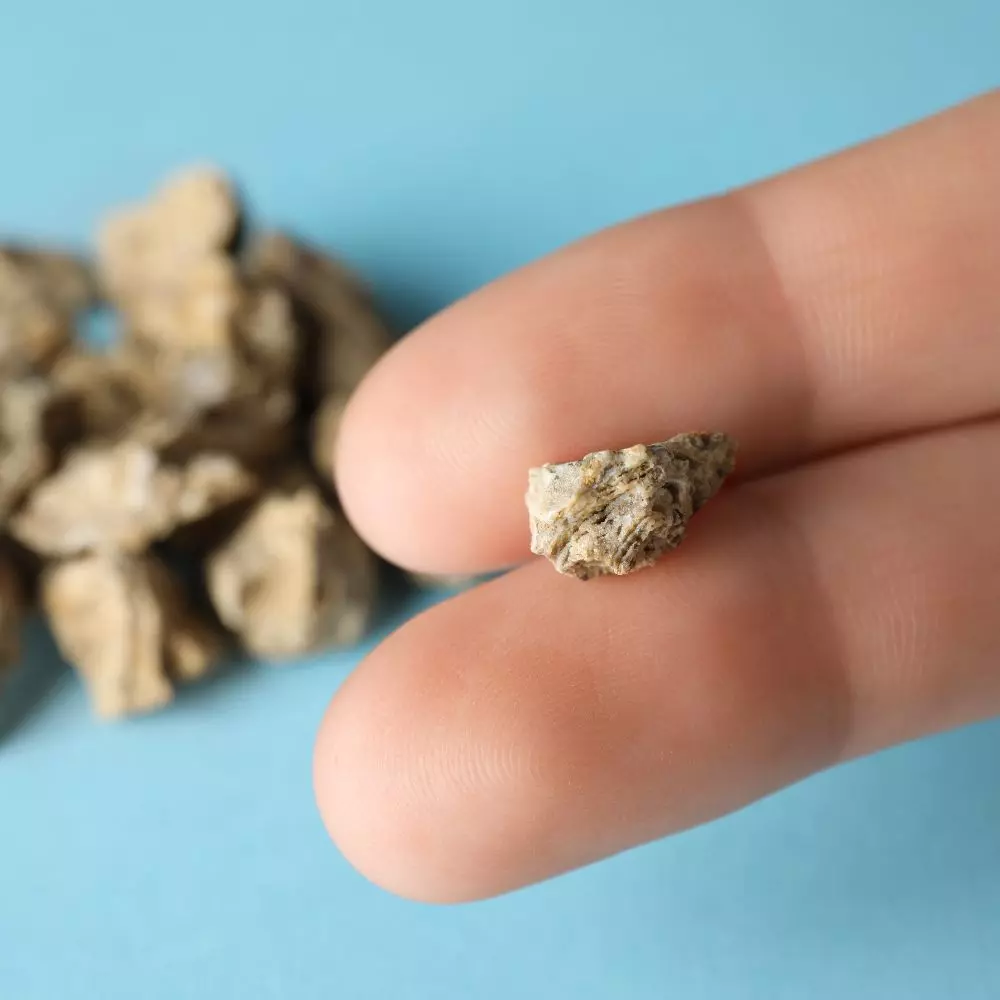 6731dfb320185d06be36478e Kidney Stones Symptoms and Treatment Options